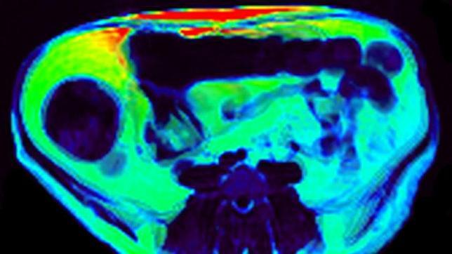 pincharse insulina para adelgazar