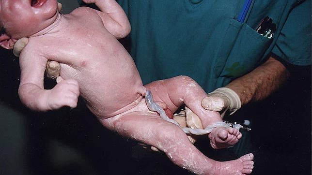 porque sangra el ombligo de un bebe recien nacido