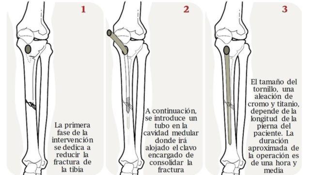 tiempo de consolidacion de fractura de tibia y perone