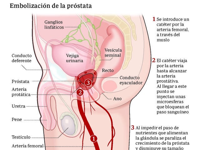 Un Tratamiento Para La Prostata Para Evitar Levantarse Al Bano Por