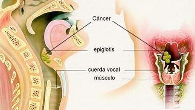 Cancer de garganta tiene cura