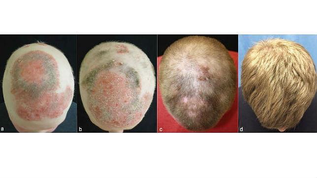 Pastillas para la alopecia difusa