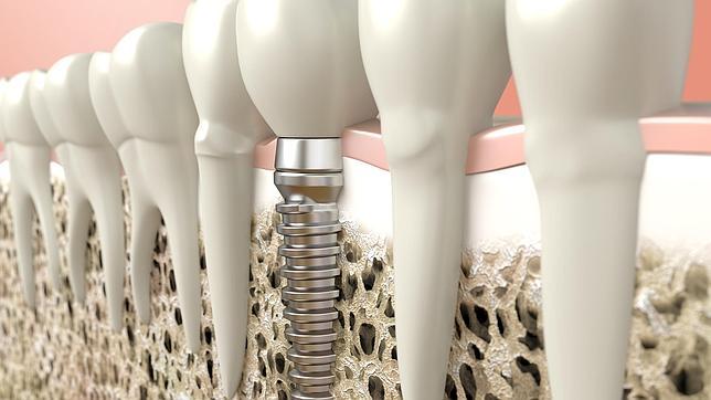 agenesia de implante dental o pontevedra