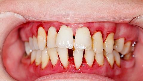 Resultado de imagen de periodontitis