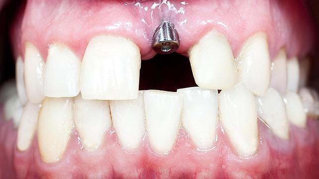 precios+de+implantes+dentales+en+españa