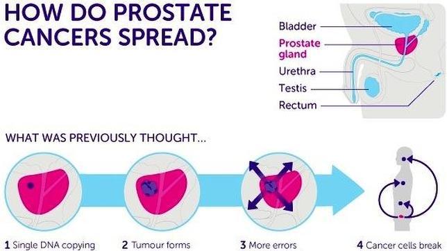 causa genetica del cancer de prostata causa genetica del cancer de prostata