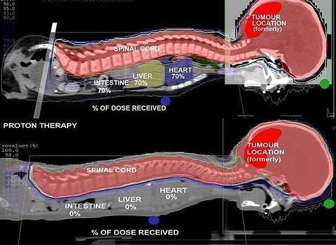 terapia de protones para el cáncer de próstata avanzado