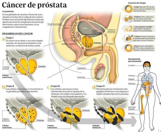 Cancer de colon operacion complicaciones - Cancer de prostata sintomas iniciais