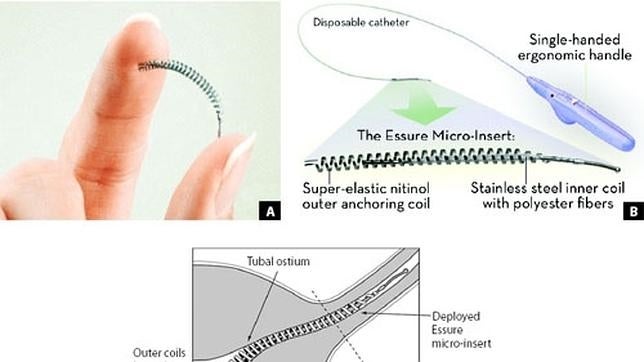 El dispositivo anticonceptivo Essure