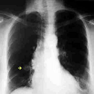 Pulmonar que significa nodulo