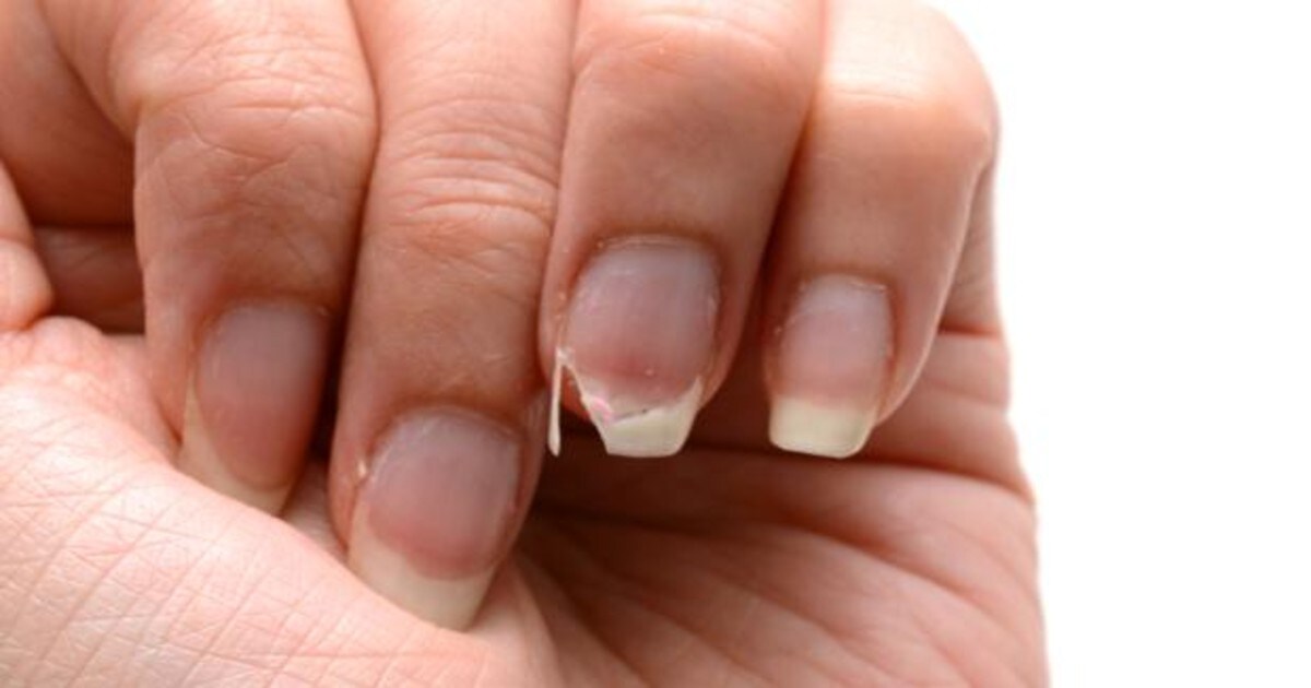 Hematoma melanoma y onicomicosis Cómo saber si las manchas de tus uñas  son peligrosas