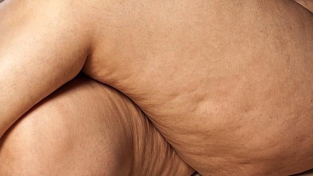 tratamientos para reducir volumen piernas