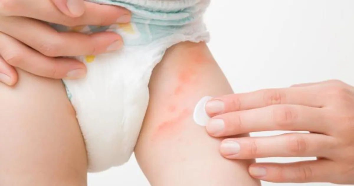 Cinco consejos para evitar la dermatitis del pañal con el calor