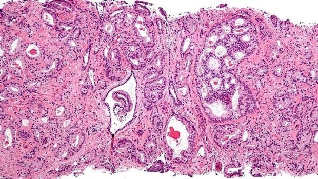 terapia hormonal para perros adenocarcinoma de próstata