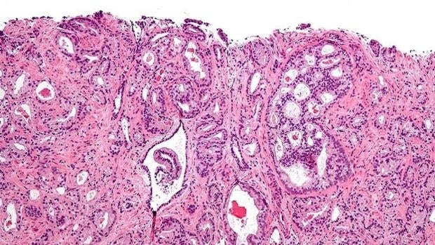 testosterona cancer de prostata testosterona cancer de prostata