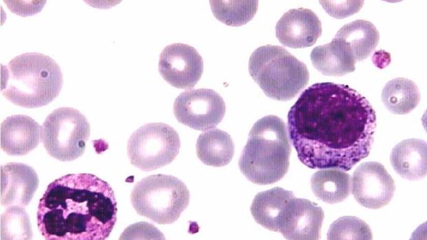 Buena leucemia
