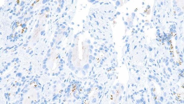 tratamiento genético molecular del cáncer de próstata tratamiento genético molecular del cáncer de próstata