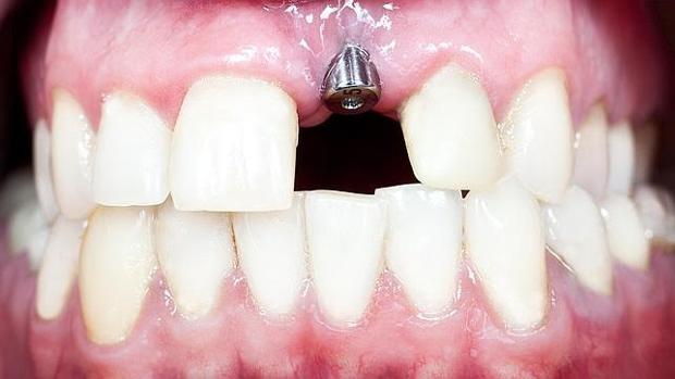 Implante dental