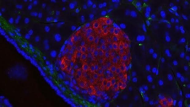 echovirus 7 síntomas de diabetes