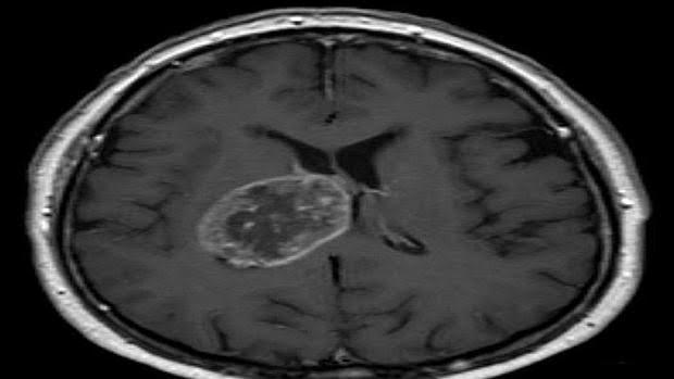 Tumor cerebral benigno tratamiento