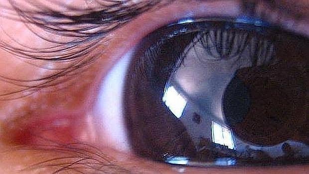 Glaucoma sintomas iniciales