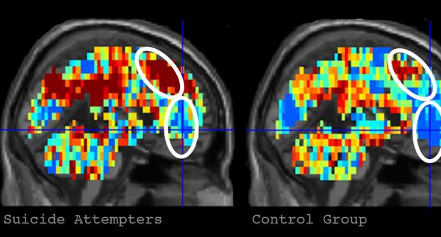 A la izquierda está el patrón de activación cerebral para "muerte" en participantes que hicieron un intento de suicidio. La imagen de la derecha muestra el patrón de activación de "muerte" en los participantes de control, mucho menos activado.