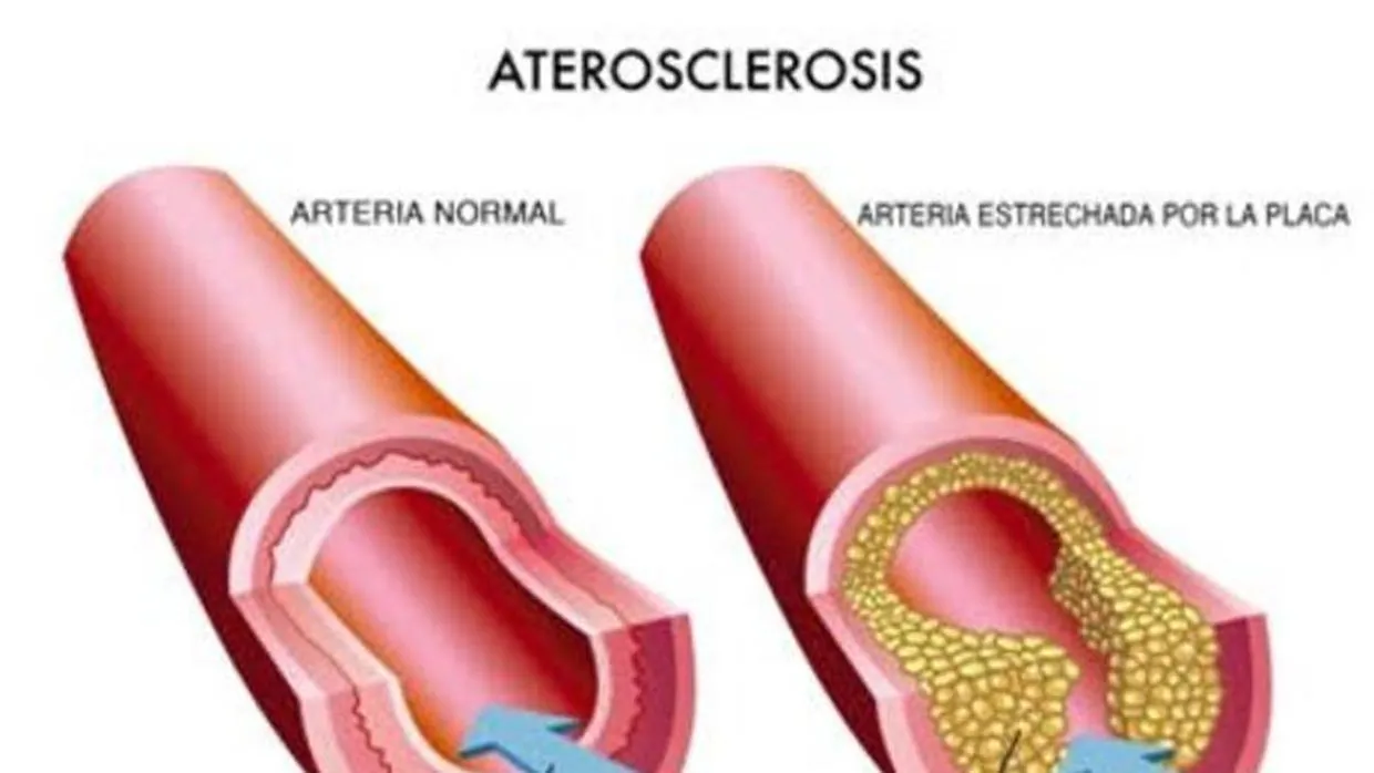 muestra de placa de aterosclerosis