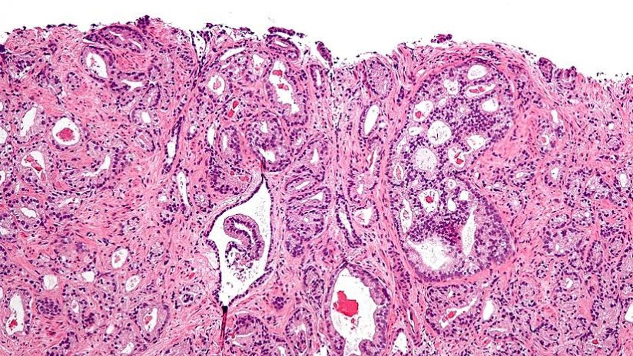 donde cubren metástasis de cáncer de próstata