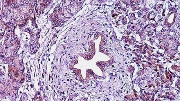 Adenocarcinoma ductal de páncreas