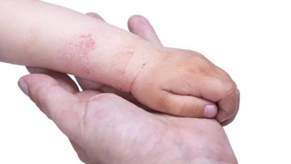 Asesor Indefinido paso Tratamiento seguro, eficaz y barato para la dermatitis atópica de niños y  adultos