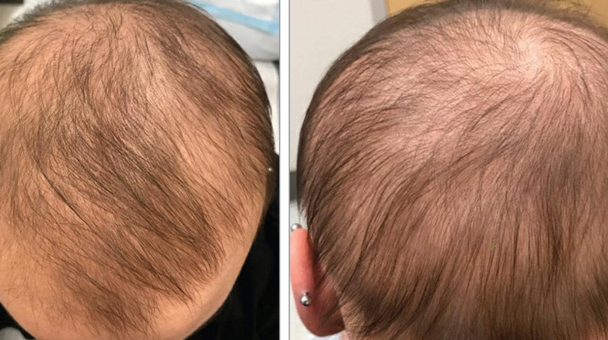 Un para la dermatitis atópica hace crecer el pelo en un caso de alopecia severa