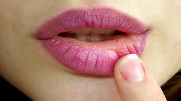 Herpes labial