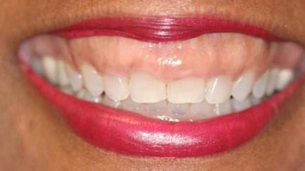 Salud dental e hipertensión relacionadas