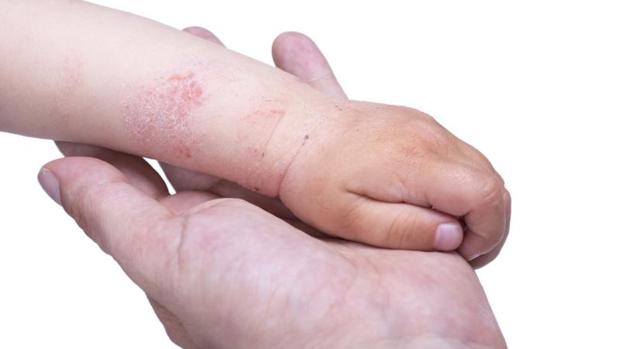 La dermatitis o eccema provoca picazón extrema en la piel