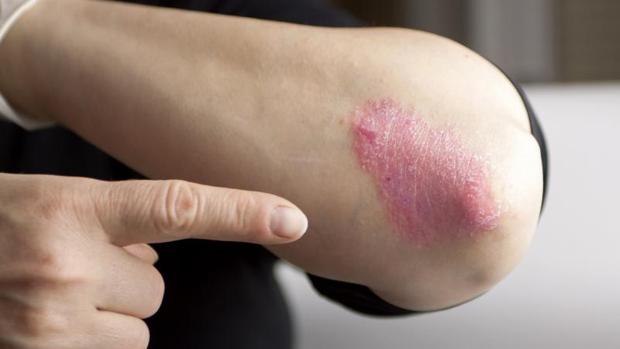 Tratamiento natural para el psoriasis