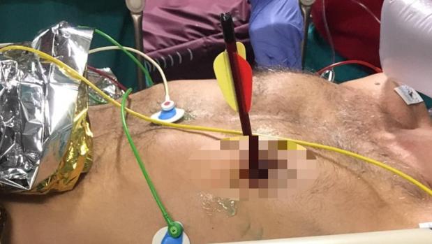 Un hombre de 47 años fue trasladado al hospital con una flecha perforando su pecho